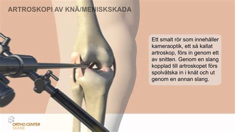 Spricka i knäskålen symptom